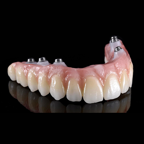 All-on-4 / All-on-6 Protezler