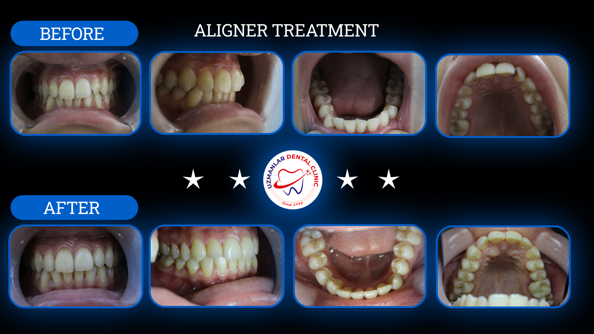 Tedavi Öncesi ve Sonrası 4