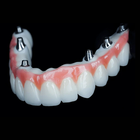 İmplant Üstü Yapılar